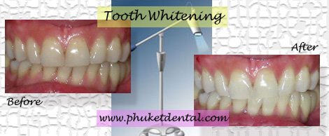 Tooth Whitening:Coldlight,non-LASER,LED,Natural Plus at Phuket Dental Clinic,Thailand